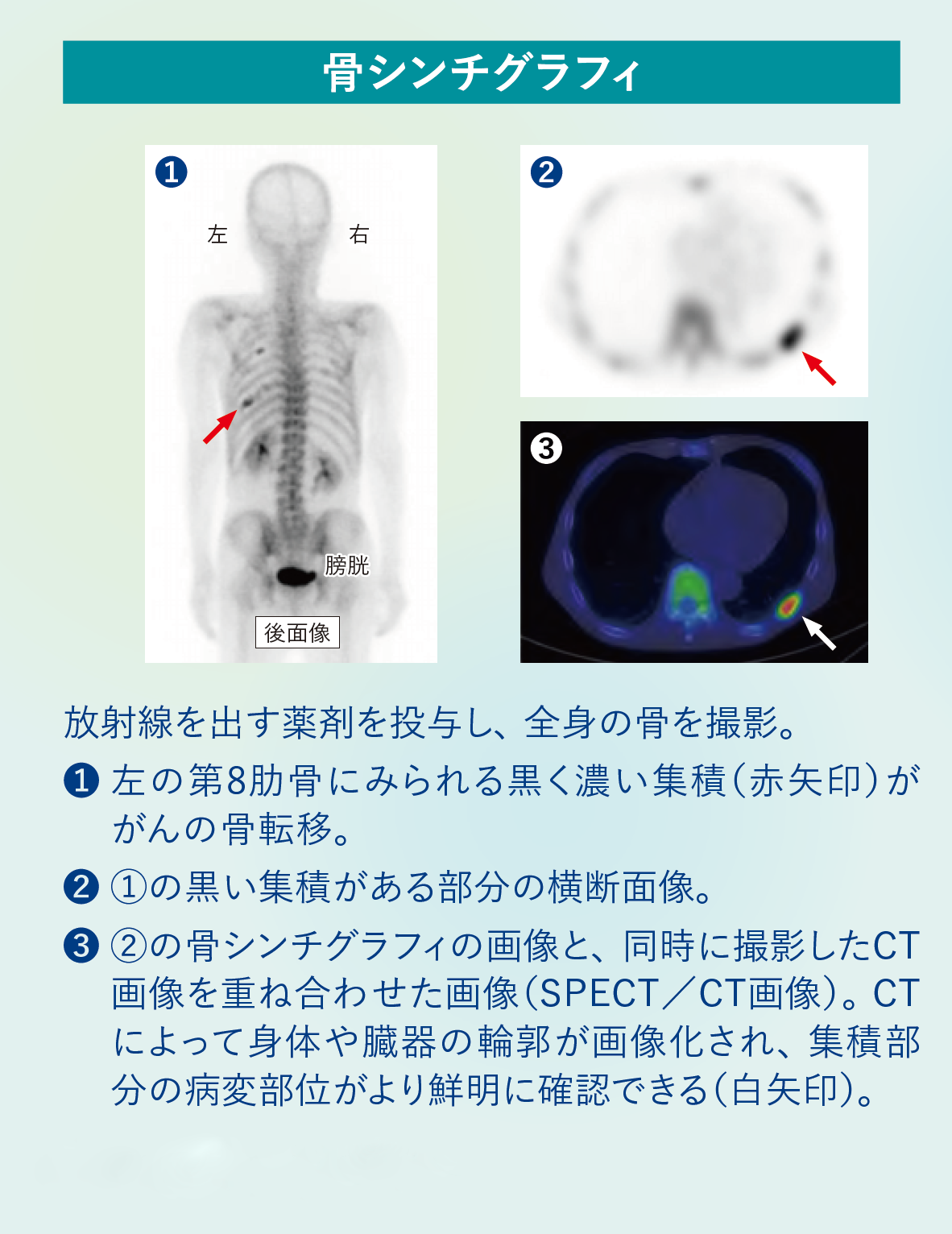 骨シンチグラフィ