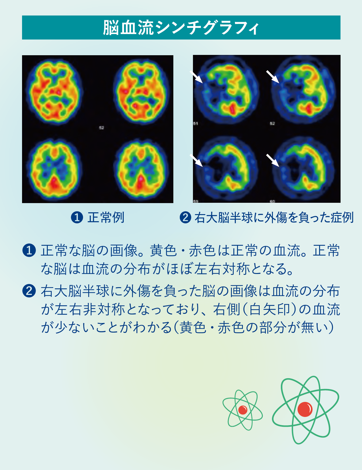 脳血流シンチグラフィ